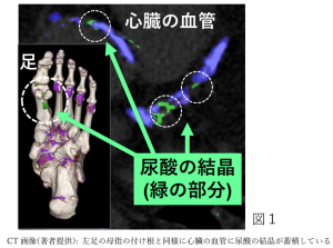 ビール、痛風、尿酸、心臓